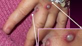 Monkeypox is on the move across Europe with France and Italy reporting first cases, while U.K. more than doubles its numbers