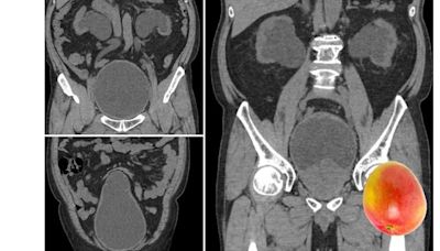 男攝護腺肥大竟如芒果併腎水腫！手術後避免腎臟、膀胱持續惡化 | 蕃新聞