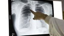 La tuberculosis a nivel mundial es la enfermedad más mortífera por delante del VIH