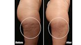 Dr. Simon Ourian Unveils New FDA-Approved Advanced Cellulite Removal Treatment