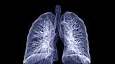 COVID-19 can cause lasting lung damage – 3 ways long COVID patients' respiration can suffer