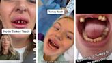 Dientes turcos: una peligrosa tendencia en Tik Tok que puede dejarte sin dentadura