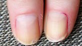 Red flag rare cancer alert that can show in your nails