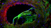 Solving the riddle of the sphingolipids in coronary artery disease