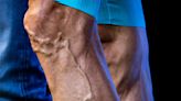 Ask The Expert: Why are my legs so veiny?