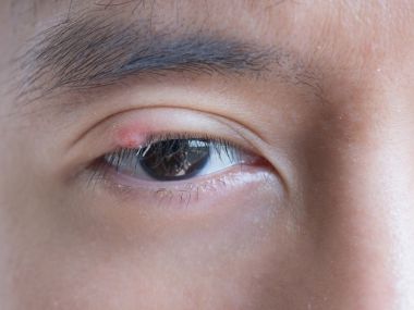 長針眼都是「這6個原因」害的！失眠、狂盯3C上榜 過來人驚吐：壓力大也會