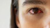40% de peruanos sufre de ojo seco y no lo sabe: el uso prolongado de pantallas digitales y la contaminación son las principales causas de esta enfermedad ocular