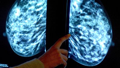 Health watchdog backs wider use of breast cancer tumour profiling tests