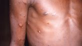 Monkeypox renamed ‘because of racism’