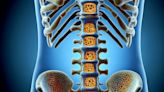 Tratamiento de la osteoporosis: ¿es igual tanto en mujeres como en hombres?