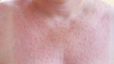 Sun Allergy: Treatment for Mild to Severe Reactions