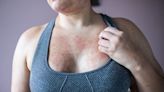 Skin Cancer and Rash: When Do Symptoms Suggest Cancer?