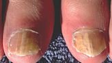 Consejos para evitar los problemas más comunes en las uñas durante el verano