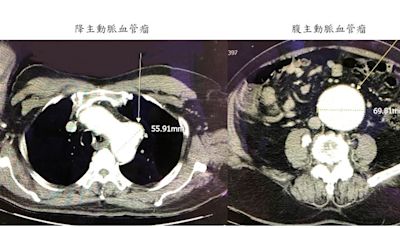 劇烈背痛後昏厥急送醫 竟是兩顆「不定時炸彈」血管瘤藏體內