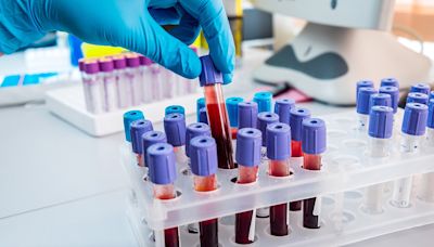 Doctors hail blood test that predicts if breast cancer will come back