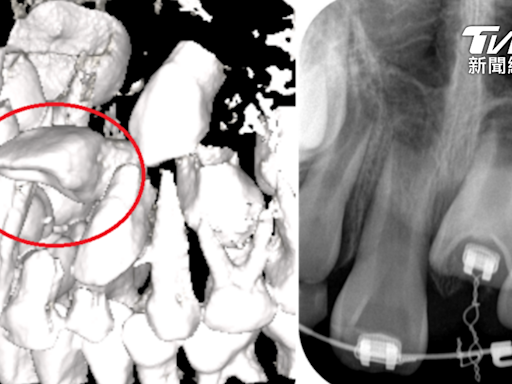 講話漏風！9歲童沒門牙不敢上學 醫一看竟「包在牙齦裡」