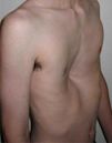 Pectus excavatum