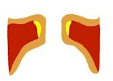 Spasmodic dysphonia