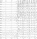 Status epilepticus