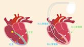 名醫會客室／「雙心室再同步節律器」治療心臟衰竭