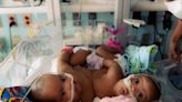 Conjoined twin sisters undergo successful surgery to separate