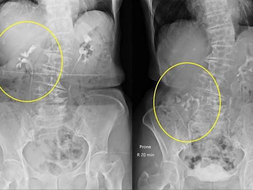 婦腰痛、頻尿竟是「腎臟離家出走」！醫：身材纖瘦女性是高危險群