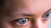 Exophthalmos (Proptosis): What You Need to Know About Bulging Eyes