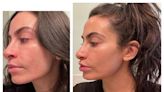 I Tried AviClear—A New Laser Treatment For Acne—And It Made a Big Difference