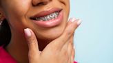 How Much Do Braces Actually Cost These Days?