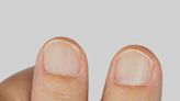 Qué hacer para eliminar las líneas o surcos en las uñas