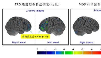 北榮首證實「頑固型憂鬱症」會遺傳 研究結果登上CNN