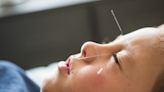 Acupuncture is ancient Chinese medicine. But does it hurt?