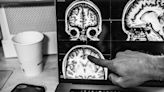 Stroke: How the aging brain may impact recovery