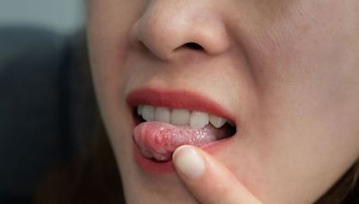 Unusual tongue symptom reported as new Covid variant causes concern