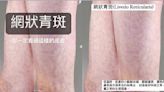 天氣變冷就爆「網狀青斑」！醫：好發在健康嬰兒、年輕女性