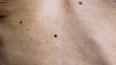 What causes 'weird red dots' on your skin – and when you should really worry