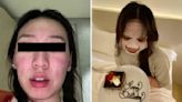 S'porean in Batam rushed to hospital after sandflies bite her face: 'I couldn't really breathe properly'