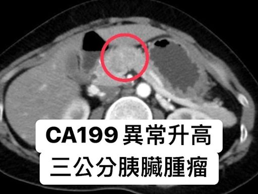 40歲女不菸不酒！照斷層驚見腫瘤「恐罹癌王」 7類人快篩檢