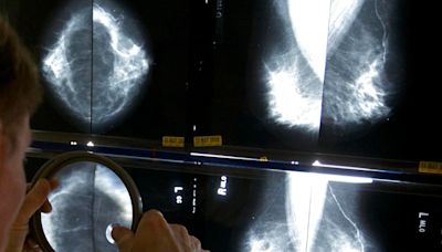 Breast Cancer Screenings Should Start At Age 40—A Decade Earlier Than Before, Task Force Says