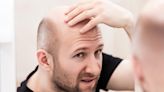 Microneedle Magic: New Alopecia Treatment Can Reverse Hair Loss