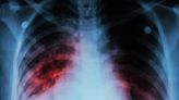 At least 14 sickened from outbreak of tuberculosis