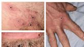 昆州新增10個猴痘病例 均為本地傳染