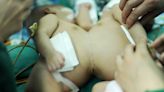 雙胞胎女嬰出生「胸腹相連」成功分離14年 身體現況曝光