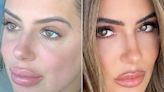 Brielle Biermann Warns Fans to Go Easy on Lip Fillers: 'Do Not Get Overfilled!’