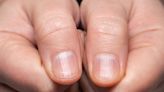 ¿Qué indican las rayas en las uñas acerca de tu salud? - El Diario NY