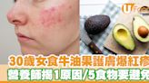 30歲女食牛油果護膚爆紅疹 營養師揭1原因 5類食物要避免 | U Food 香港餐廳及飲食資訊優惠網站