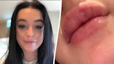 Woman’s warning after lip filler left her unable to close mouth