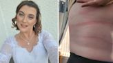 Woman’s rare allergy to pressure on her skin means she can’t wear jeans or a bra