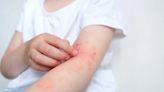 Una campaña gratuita busca detectar pacientes con dermatitis atópica para mejorar su calidad de vida