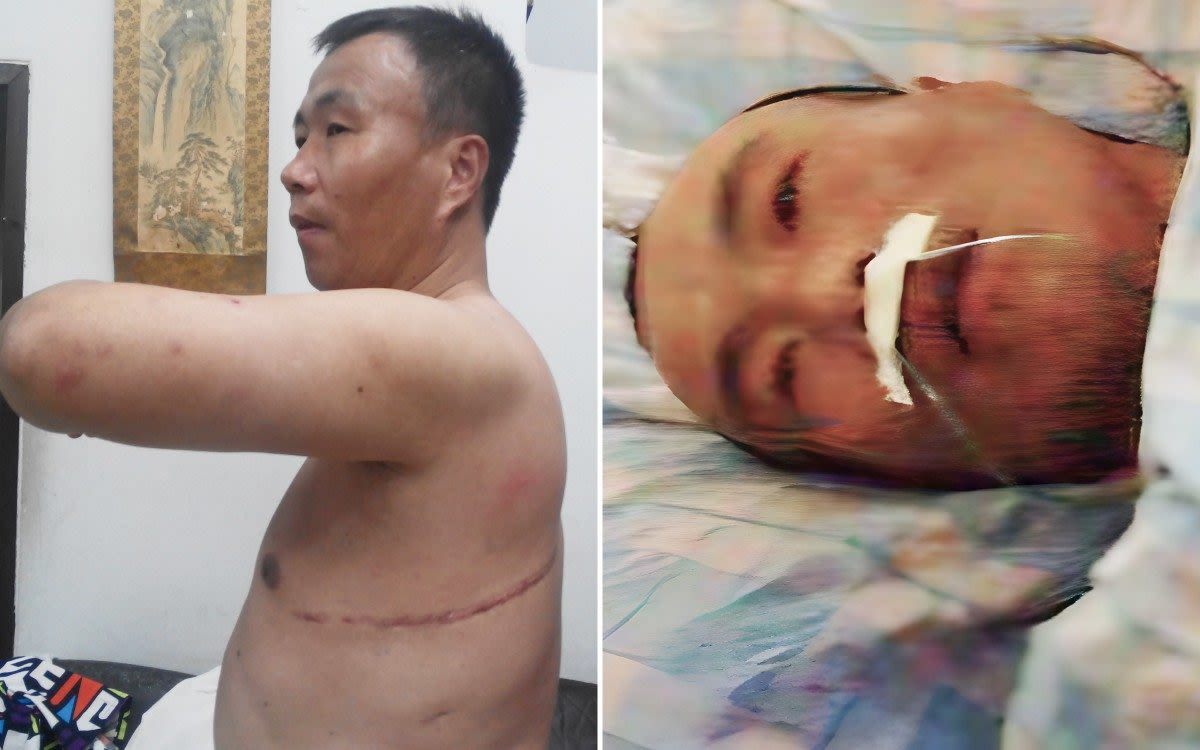 Chinese organ harvesting victim woke up chained to bed with parts of liver and lung missing